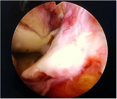 Clinical effect of day case arthroscopic surgery in tibial-eminence fracture in adults using button plates